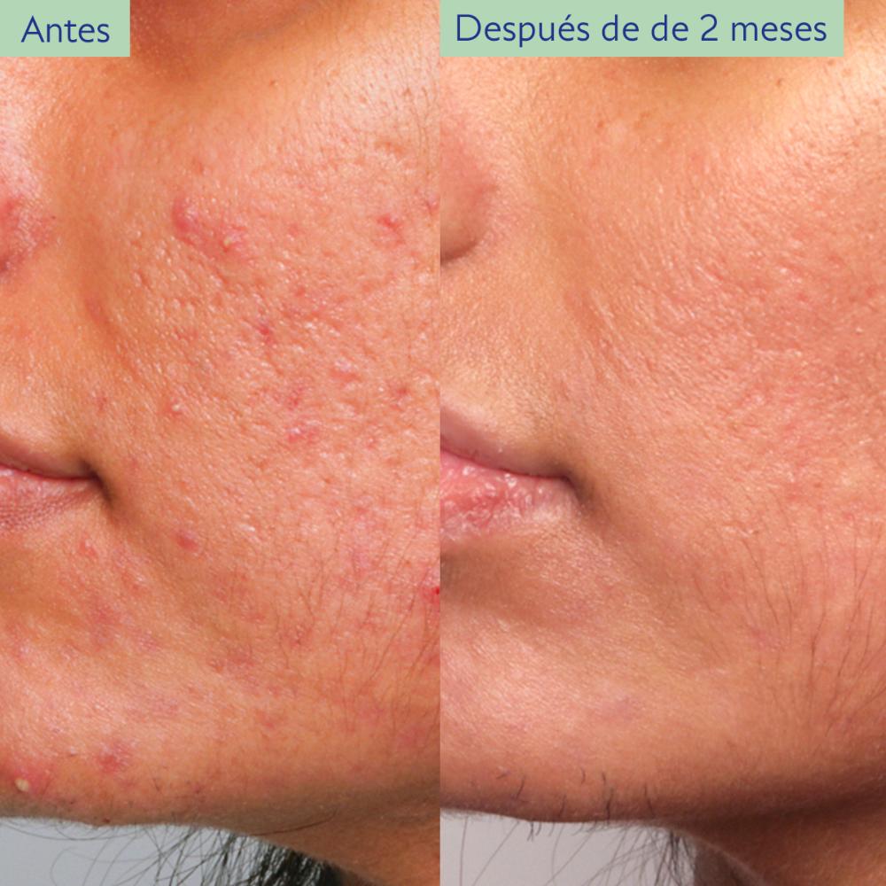 ESENCIALES PARA PIEL CON TENDENCIA ACNEICA (SET PARA EL CUIDADO DE PIEL)